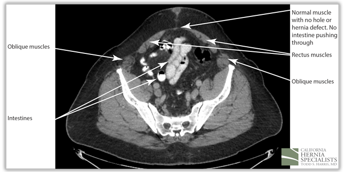 Recurrent Ventral Hernia CT Image